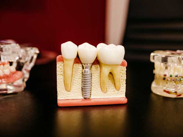 Replacing Missing Teeth With Implans