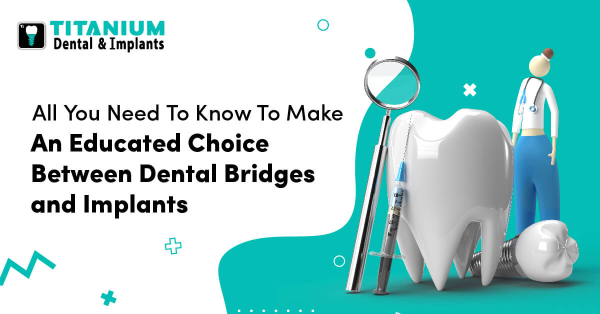 All You Need To Know To Make An Educated Choice Between Dental Bridges and Implants