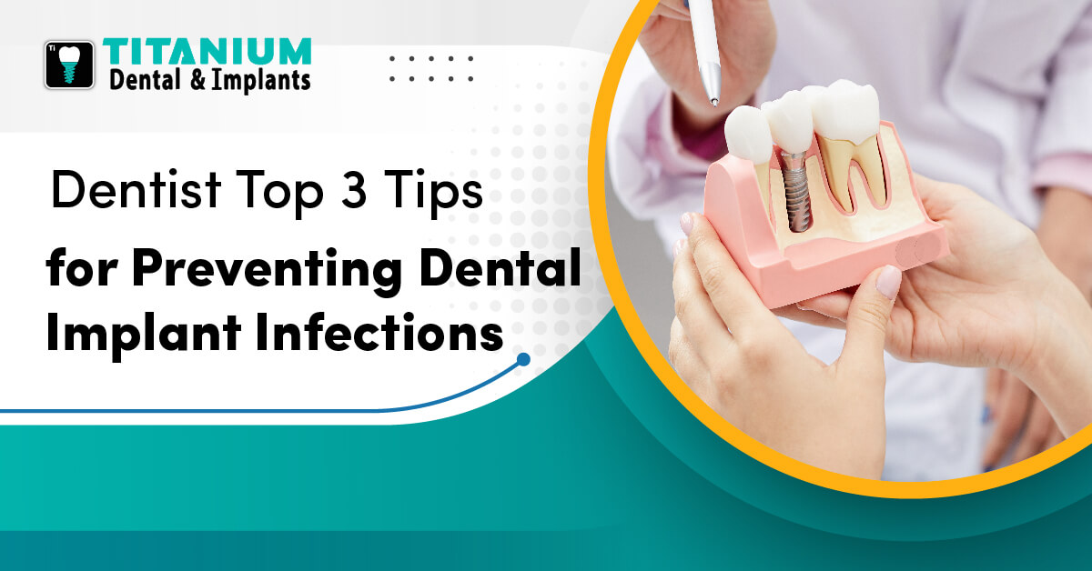 Dentist Top 3 Tips for Preventing Dental Implant Infections