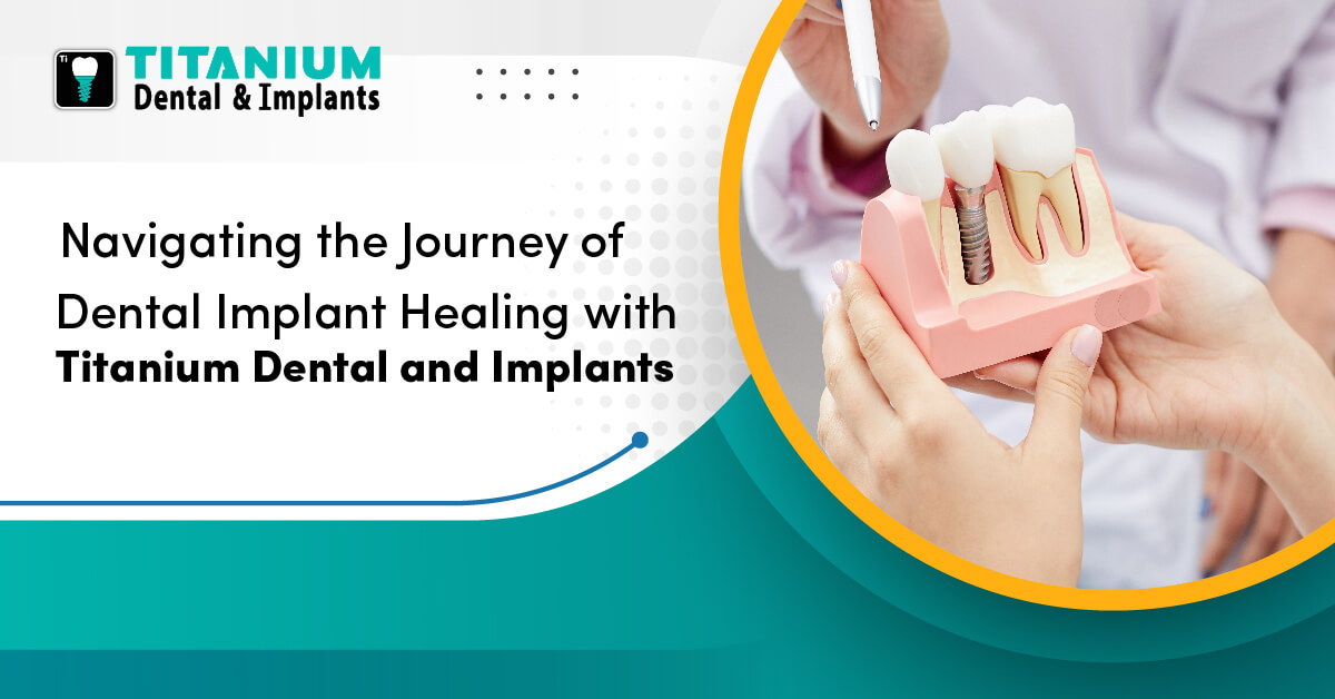 Navigating the Journey of Dental Implant Healing